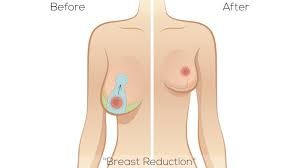 Clinictor - Affordable Breast Reduction India