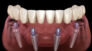 Clinictor - A Comprehensive Comparison of All-on-4 Implants vs. Traditional Dentures Choosing the Right Dental Solution in the UK
