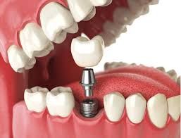 Clinictor - All-on-4 Implants vs. Traditional Dentures A Comprehensive Guide for Dental Solutions in Greece
