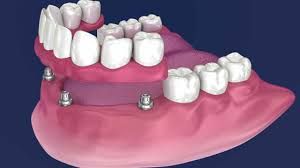 Clinictor - All-on-4 Implants vs. Traditional Dentures A Comprehensive Guide to Dental Solutions in India