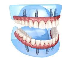 Clinictor - All-on-4 Implants vs. Traditional Dentures A Comprehensive Guide to Dental Solutions in Ireland