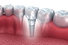 Clinictor - All-on-4 Implants vs. Traditional Dentures A Detailed Guide to Dental Solutions in Romania