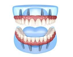 Clinictor - All-on-4 Implants vs. Traditional Dentures Choosing the Right Dental Solution in Germany
