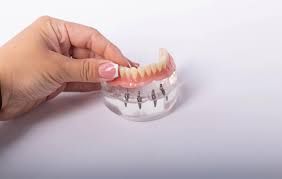 Clinictor - Comprehensive Guide to All-on-4 Implants and Traditional Dentures Choosing the Right Solution in Turkey