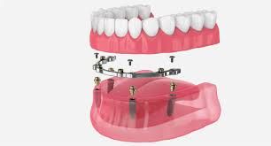 Clinictor - Discover Your Smile in South Korea All-on-4 Implants vs. Traditional Dentures