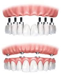 Clinictor - Rediscover Your Smile in Greece Exploring All-on-4 Implants vs. Traditional Dentures