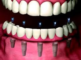 Clinictor - Rediscover Your Smile in Spain All-on-4 Implants vs. Traditional Dentures