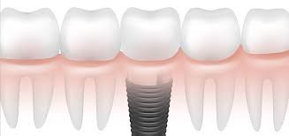 Clinictor - Restore Your Smile in Japan A Guide to All-on-4 Implants vs. Traditional Dentures