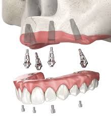 blog-image