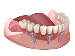 Clinictor - The Ultimate Guide to Dental Restoration All-on-4 Implants vs. Traditional Dentures in Singapore