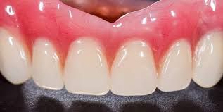 Clinictor - Transforming Smiles in Brazil All-on-4 Implants vs. Traditional Dentures—Which is Right for You?
