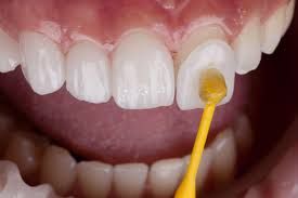 Clinictor - Achieving a Brighter Smile with Dental Veneers in Germany A Comprehensive Guide
