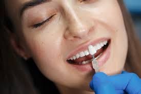 Clinictor - Achieving a Perfect Smile with Dental Veneers in the Netherlands An In-Depth Guide