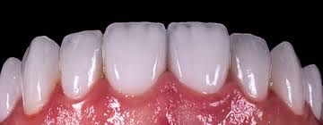 Clinictor - Discover How Dental Veneers in Turkey Can Enhance Your Smile and Confidence