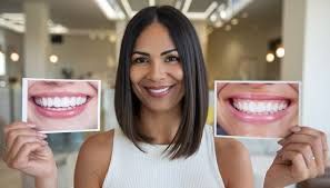 Clinictor - Enhancing Your Smile with Dental Veneers in Thailand A Complete Guide