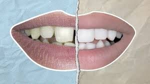 Clinictor - Transform Your Smile with Dental Veneers in Italy A Complete Guide