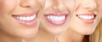 Clinictor - Transform Your Smile with Dental Veneers in South Korea A Comprehensive Guide