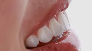 Clinictor - Transforming Your Smile with Dental Veneers in Romania A Comprehensive Guide