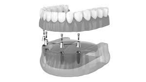 Clinictor - Discover Why Ireland is a Leading Destination for Full-Mouth Dental Reconstruction
