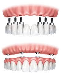 Clinictor - Why Brazil is the Perfect Destination for Full-Mouth Dental Reconstruction