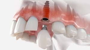 Clinictor - Why Thailand is the Ultimate Destination for Full-Mouth Dental Reconstruction?