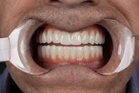Clinictor - Why the United Kingdom is an Excellent Destination for Full-Mouth Dental Reconstruction