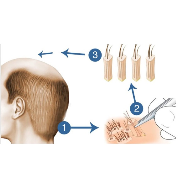 Cancun Hair Transplant - Clinictor