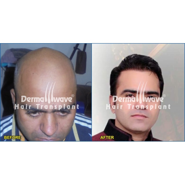 Dermawave Hair Transplant and Dermacare Skin & Laser Cdentre - Clinictor
