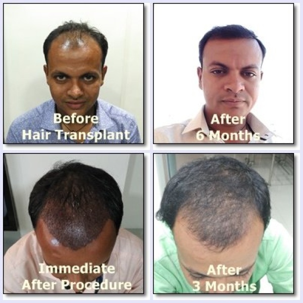 Dev Hair Transplant Clinic - Clinictor
