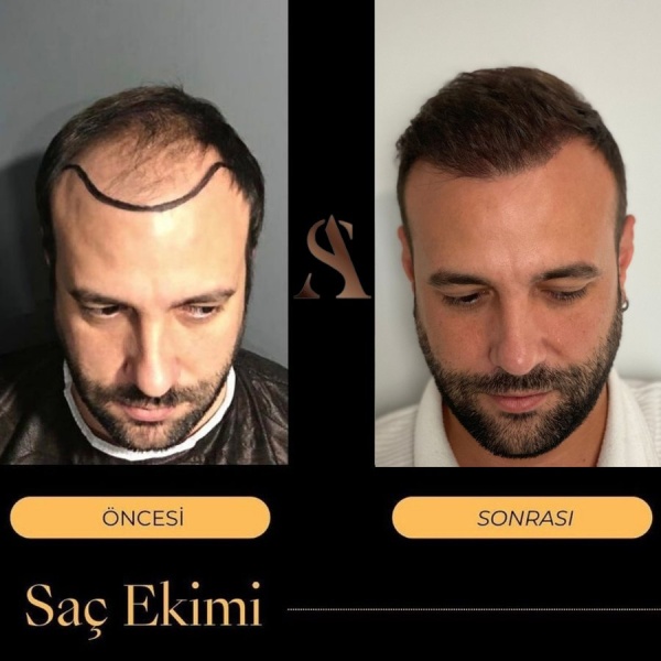 Dr. Ali Şahan Hairclinic - Clinictor