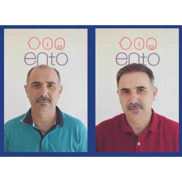 ENTO Medical Center Hair Transplant Clinic - Clinictor