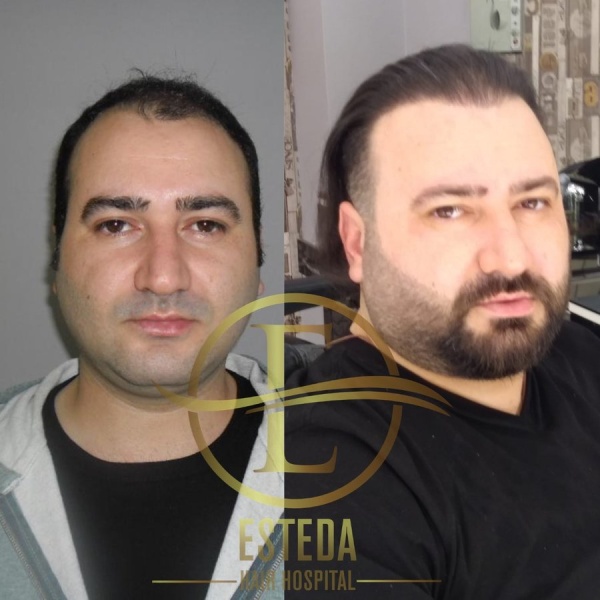 Esteda Hair Transplant Hospital - Clinictor