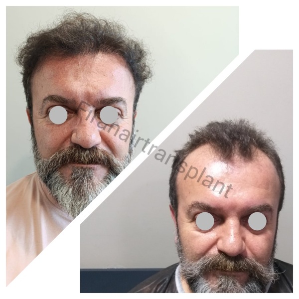 Fira Hair Transplant - Clinictor