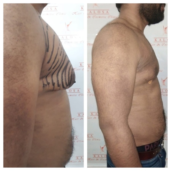 Kalosa - Hair & Cosmetic Clinic-New Delhi - Clinictor