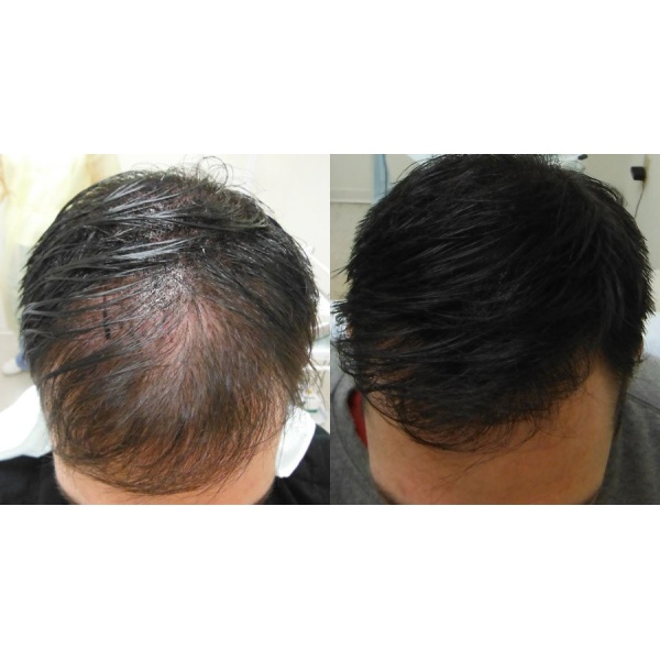 Scalp Micropigmentation Clinic - HeadPower - Clinictor