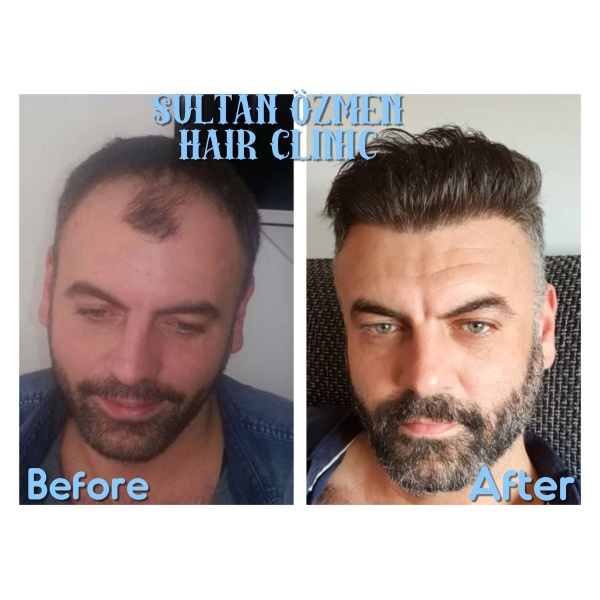 Sultan Özmen Hair Clinic - Clinictor