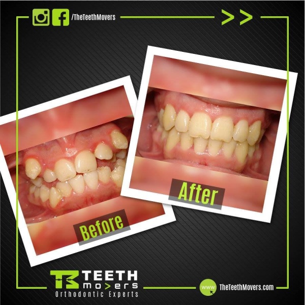 The Teeth Movers - Clinictor